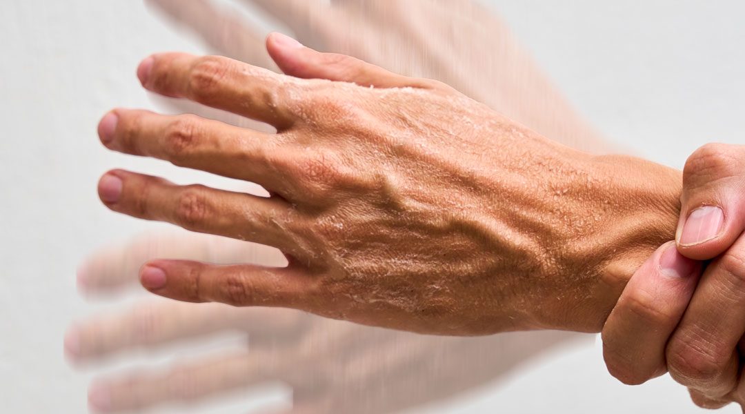 PARKINSON’S EUROPE CONTRO LA “CATTIVA SEMPLIFICAZIONE”