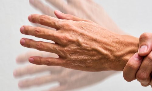 PARKINSON’S EUROPE CONTRO LA “CATTIVA SEMPLIFICAZIONE”